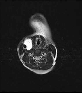 File:Bilateral carotid body tumors and right jugular paraganglioma (Radiopaedia 20024-20060 Axial 44).jpg