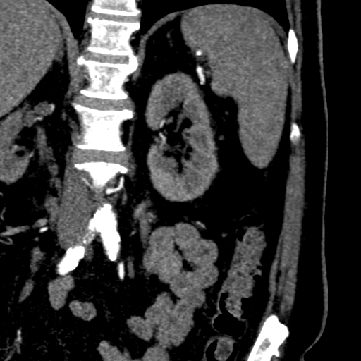 File:Bilateral delayed nephrogram from renal artery stenosis (Radiopaedia 47681-52362 B 14).png