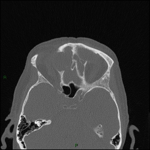 Bilateral frontal mucoceles (Radiopaedia 82352-96454 Axial bone window 123).jpg