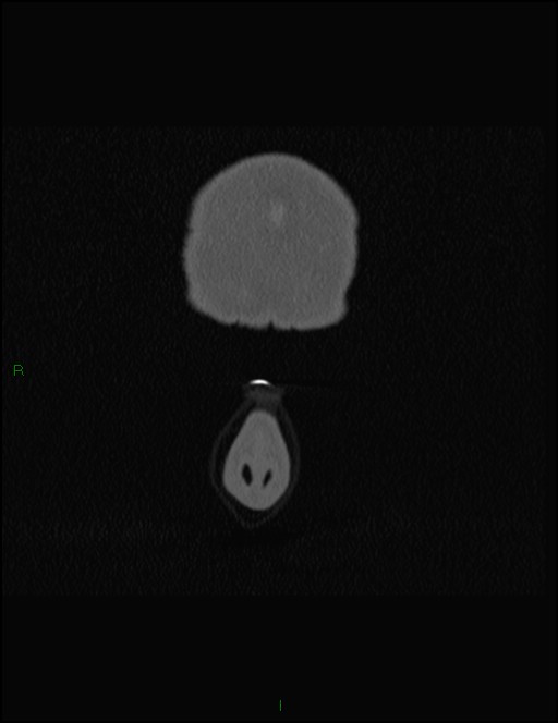Bilateral frontal mucoceles (Radiopaedia 82352-96454 Coronal 15).jpg
