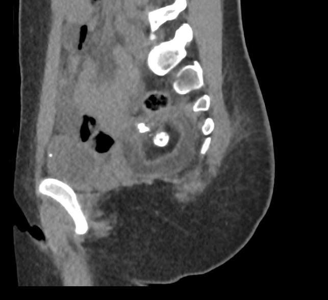 Bilateral mature cystic ovarian teratoma (Radiopaedia 88821-105592 D 44).jpg