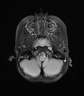 File:Bilateral mesial temporal polymicrogyria (Radiopaedia 76456-88181 Axial FLAIR 3).jpg