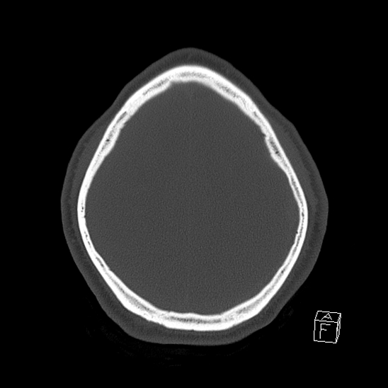 Bilateral occipital condyle fracture (type 2) (Radiopaedia 87675-104089 Axial bone window 110).jpg