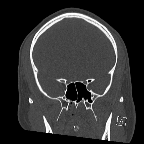 File:Bilateral occipital condyle fracture (type 2) (Radiopaedia 87675-104089 Coronal bone window 39).jpg