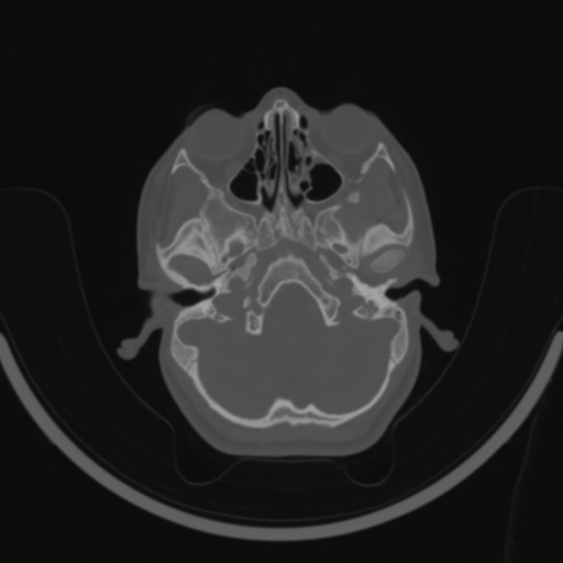 Bilateral otosclerosis (Radiopaedia 57237-64157 C 28).jpg