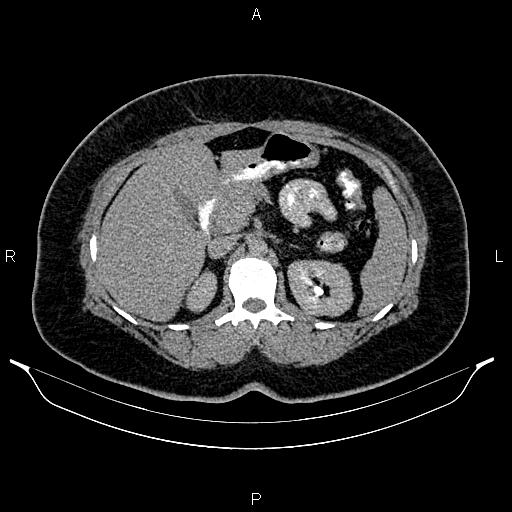 Bilateral ovarian dermoid cysts (Radiopaedia 85785-101603 Axial C+ delayed 20).jpg