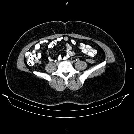 File:Bilateral ovarian dermoid cysts (Radiopaedia 85785-101603 Axial C+ delayed 51).jpg