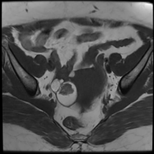 File:Bilateral ovarian dermoid cysts (Radiopaedia 90152-107338 Axial T1 10).jpg