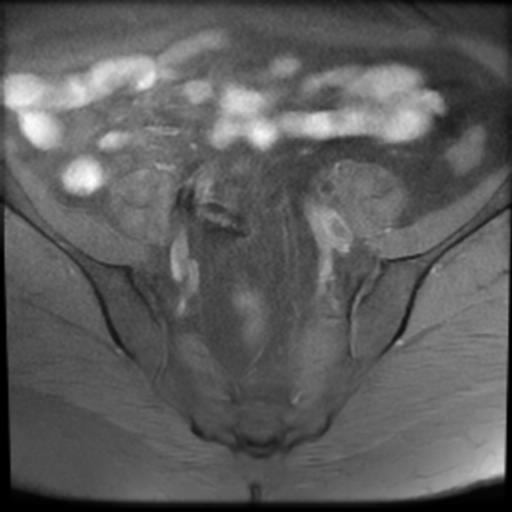 File:Bilateral ovarian dermoid cysts (Radiopaedia 90152-107338 Axial T1 fat sat 5).jpg