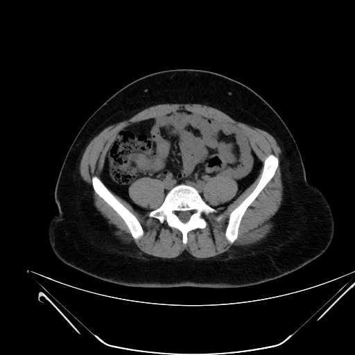 File:Bilateral ovarian mature cystic teratomas (Radiopaedia 79373-92457 Axial non-contrast 37).jpg