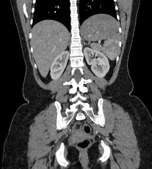 Bilateral ovarian mature cystic teratomas (Radiopaedia 79373-92457 B 68).jpg