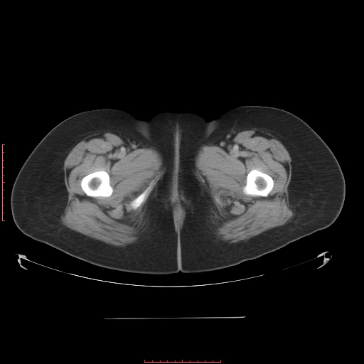File:Bilateral ovarian serous cystadenocarcinoma with right ovarian torsion (Radiopaedia 32640-33611 A 47).jpg
