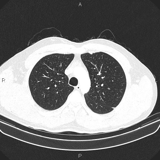 File:Bilateral pulmonary AVM (Radiopaedia 83134-97505 Axial lung window 22).jpg