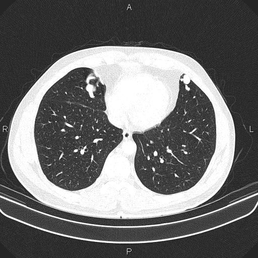 File:Bilateral pulmonary AVM (Radiopaedia 83134-97505 Axial lung window 52).jpg