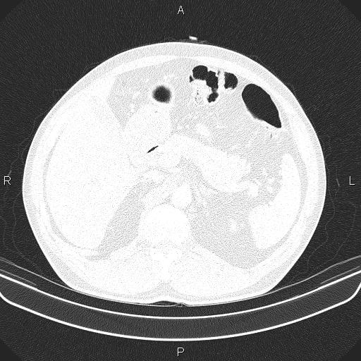 File:Bilateral pulmonary AVM (Radiopaedia 83134-97505 Axial lung window 78).jpg