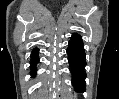 Bilateral pulmonary AVM (Radiopaedia 83134-97505 C 69).jpg