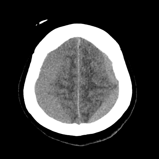 Bilateral subacute subdural hematoma (Radiopaedia 69240-79018 Axial non-contrast 42).jpg