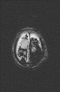 Bilateral subdural hemorrhage and parietal skull fracture (Radiopaedia 26058-26190 Axial SWI 76).png