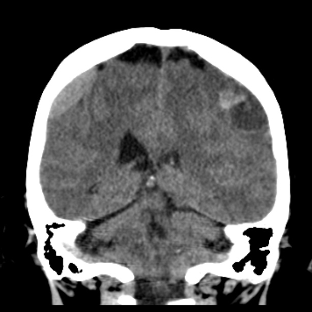 Bilateral subdural hemorrhages (Radiopaedia 26588-26732 Coronal non-contrast 39).jpg