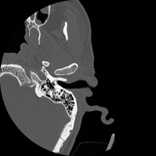 Bilateral temporal bone fractures (Radiopaedia 29482-29970 D 48).jpg