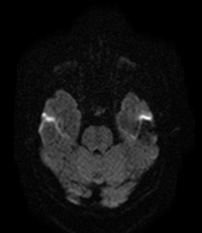 File:Bilateral thalamic glioma (Radiopaedia 65852-75009 Axial DWI 6).jpg