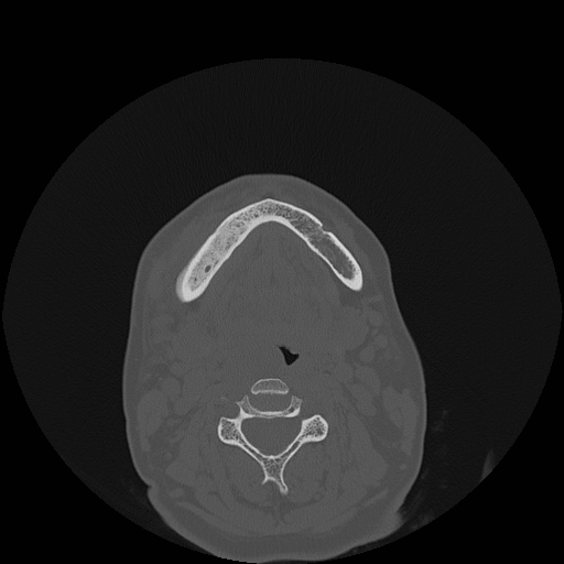 File:Bisphosphonate-related osteonecrosis of the jaw (Radiopaedia 71324-81642 Axial bone window 39).jpg
