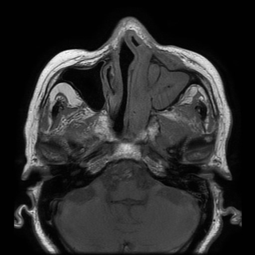 Bisphosphonate-related osteonecrosis of the maxilla (Radiopaedia 51367-57101 Axial T1 31).jpg