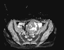 File:Bladder rhabdomyosarcoma (Radiopaedia 27231-27407 Axial ADC 14).jpg