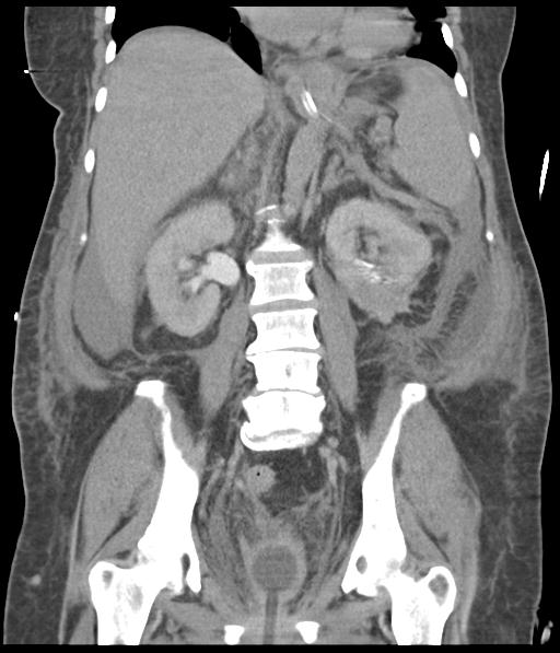 File:Bladder rupture post renal biopsy (Radiopaedia 30863-31572 Coronal non-contrast 37).jpg