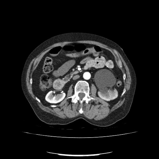 File:Bladder tumor detected on trauma CT (Radiopaedia 51809-57609 A 110).jpg