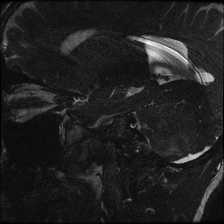 Blake's pouch cyst (Radiopaedia 75680-87010 Sagittal T2 1).jpg