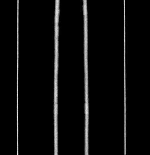 Blind-ending branch of a bifid ureter (Radiopaedia 61159-69048 F 78).jpg