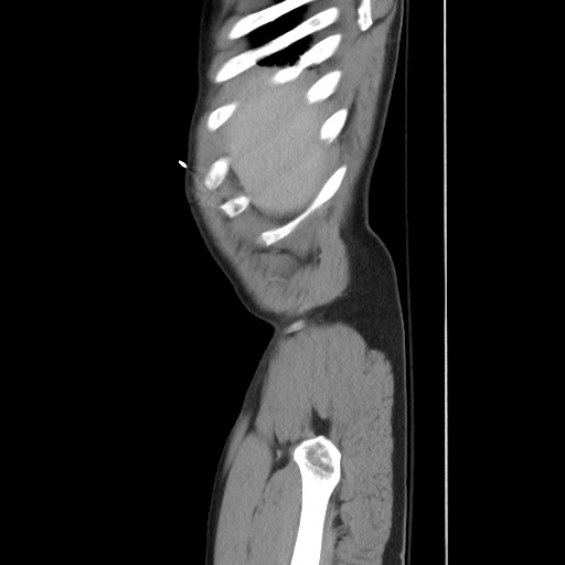 File:Blunt abdominal trauma with solid organ and musculoskelatal injury with active extravasation (Radiopaedia 68364-77895 C 24).jpg