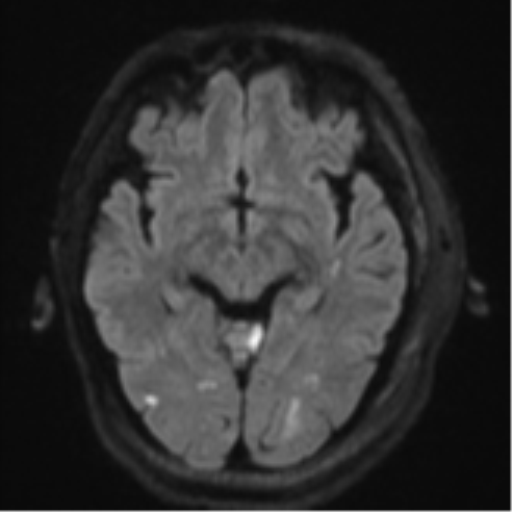 Blunt cerebrovascular injury (Radiopaedia 53682-59745 Axial DWI 44).png