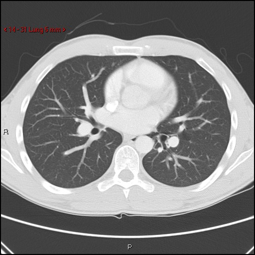 Blunt chest trauma - pulmonary interstitial emphysema and pneumomediastinum (Radiopaedia 20666-20552 Axial lung window 31).jpg