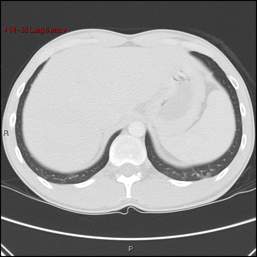 File:Blunt chest trauma - pulmonary interstitial emphysema and pneumomediastinum (Radiopaedia 20666-20552 Axial lung window 55).jpg
