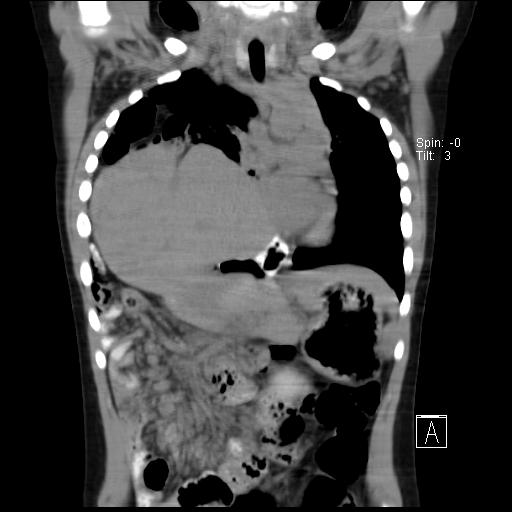File:Bochdalek diaphragmatic hernia (Radiopaedia 38866-41059 Coronal liver window 10).jpg