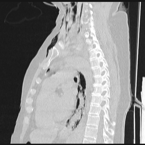 Boerhaave syndrome (Radiopaedia 45644-49799 Sagittal lung window 47).jpg