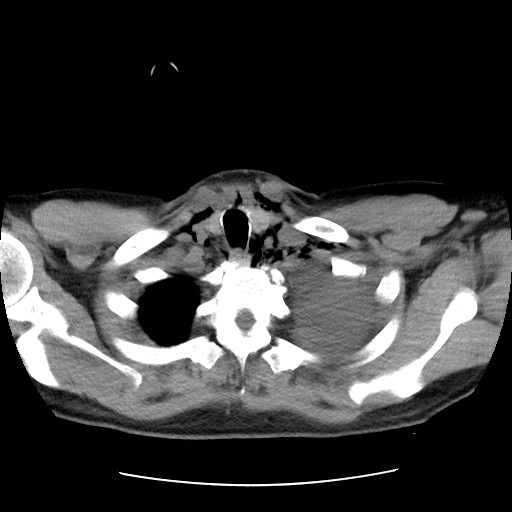 Boerhaave syndrome (Radiopaedia 59796-67310 Axial liver window 10).jpg