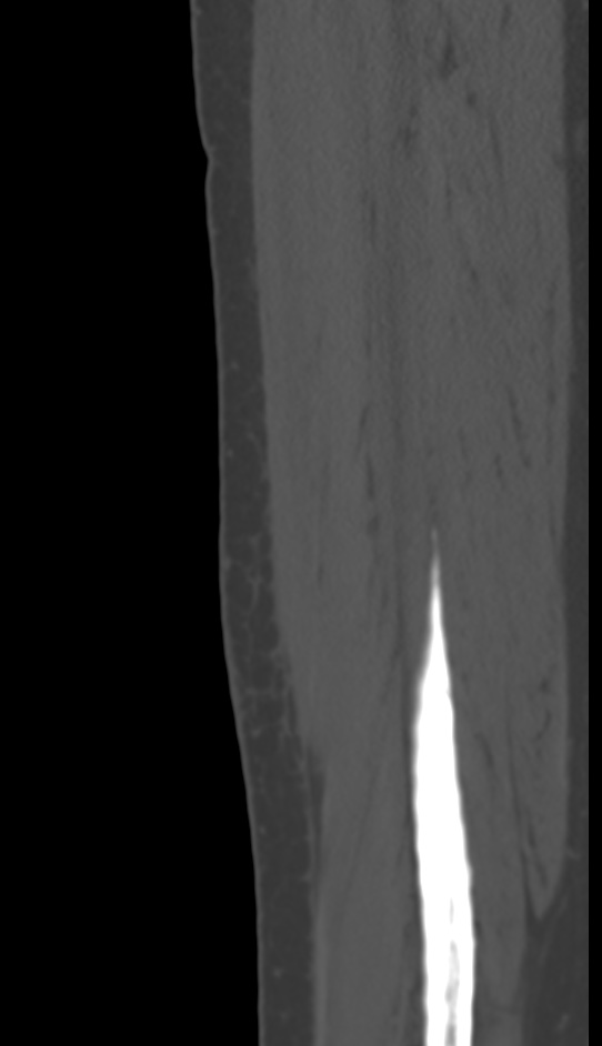 Bone metastasis - tibia (Radiopaedia 57665-64609 Sagittal bone window 145).jpg