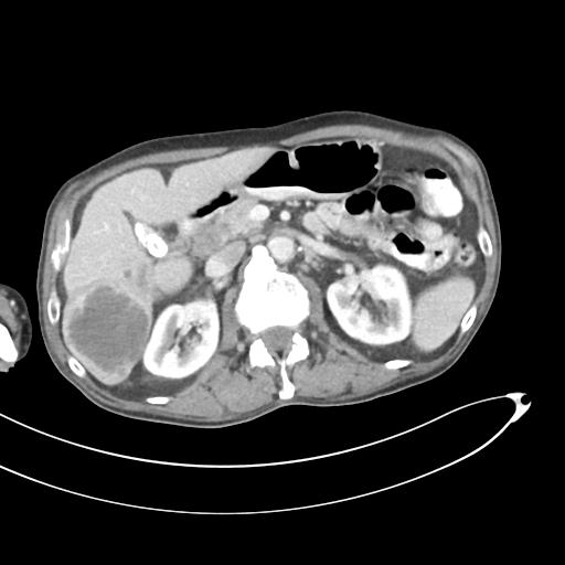 Bone metastasis from squamous cell carcinoma (Radiopaedia 30133-30730 B 26).jpg