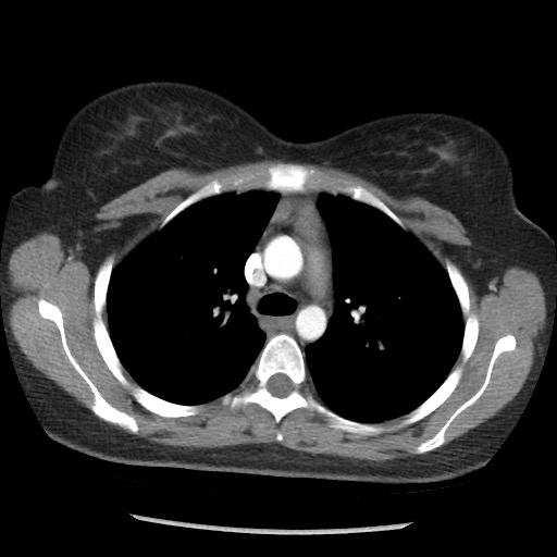 File:Borderline mucinous tumor (ovary) (Radiopaedia 78228-90808 A 17).jpg
