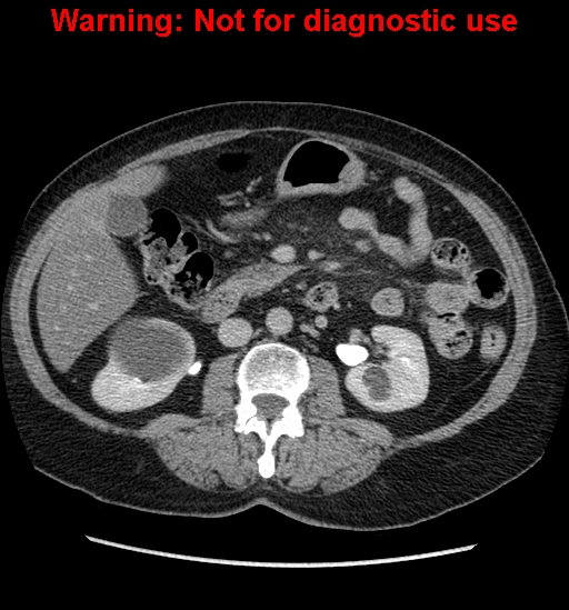 File:Bosniak renal cyst - type II (Radiopaedia 23404-23468 F 27).jpg