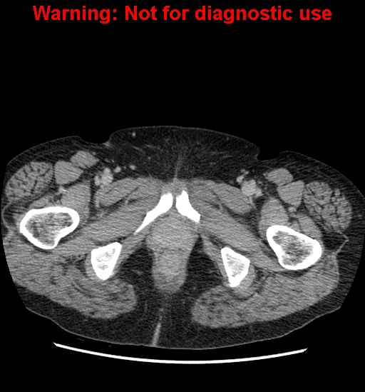 File:Bosniak renal cyst - type II (Radiopaedia 23404-23468 F 71).jpg