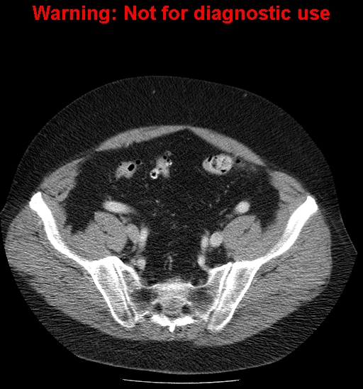 File:Bosniak renal cyst - type IV (Radiopaedia 23402-23466 D 62).jpg