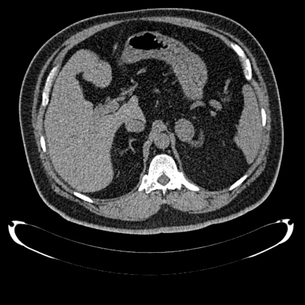 Bosniak renal cyst - type IV (Radiopaedia 24244-24518 Axial non-contrast 118).jpg