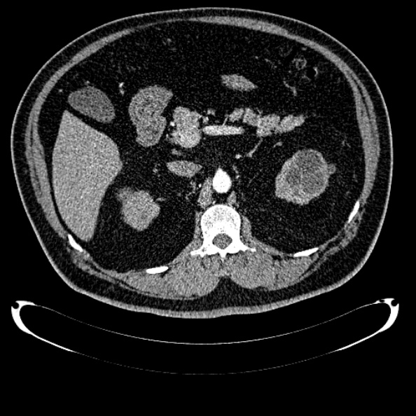 Bosniak renal cyst - type IV (Radiopaedia 24244-24518 B 112).jpg