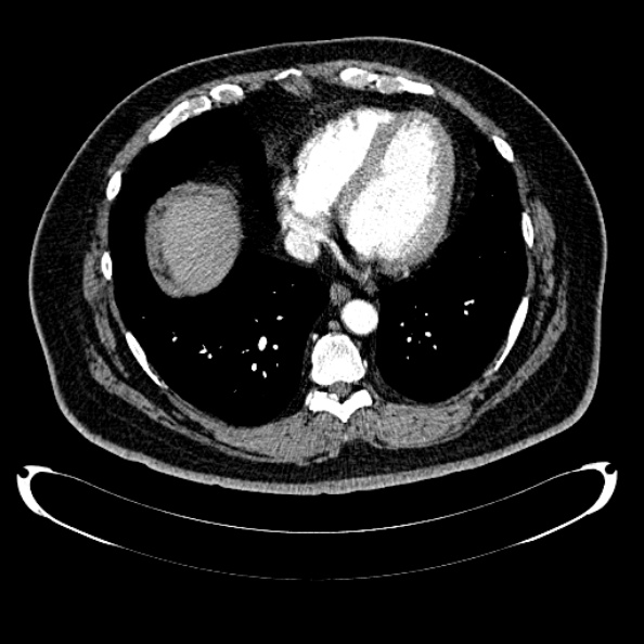 File:Bosniak renal cyst - type IV (Radiopaedia 24244-24518 B 4).jpg