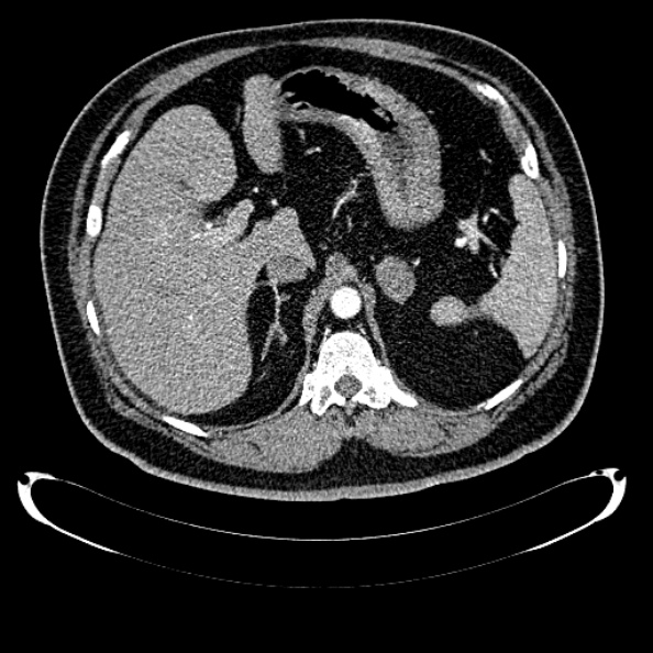 Bosniak renal cyst - type IV (Radiopaedia 24244-24518 B 77).jpg