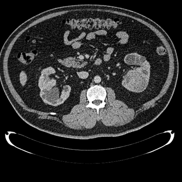 File:Bosniak renal cyst - type IV (Radiopaedia 24244-24518 C 159).jpg